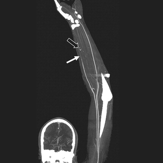 CT Angiography Arterial Upper Limb Test